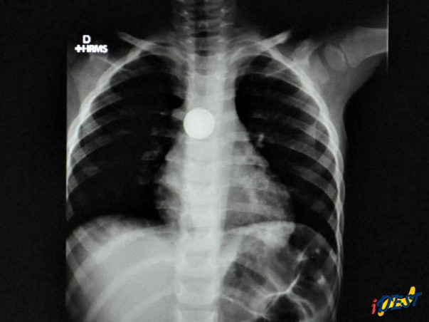Radiografia mostra pilha de controle de aparelho de som presa no esôfago.