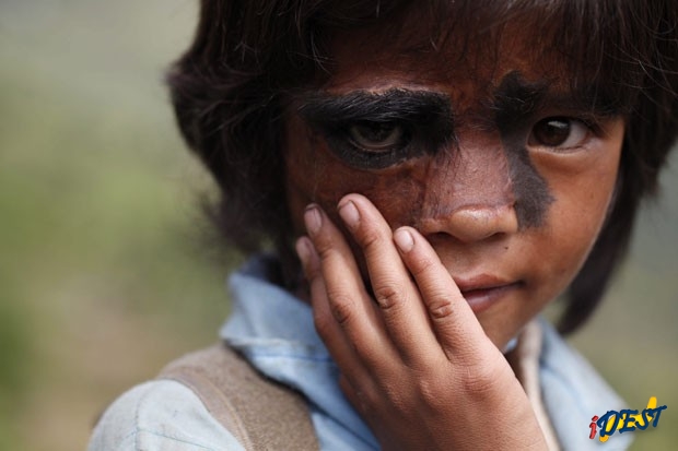 Bhawana Thami posa tímida para o fotógrafo em Dusikharka, a 345 km de Catmandu, meses depois de ter passado pela primeira cirurgia